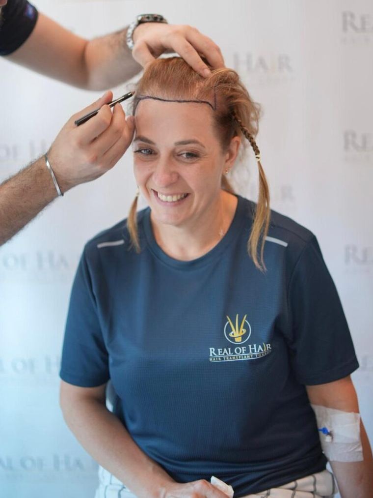 Hairline being drawn for a female patient